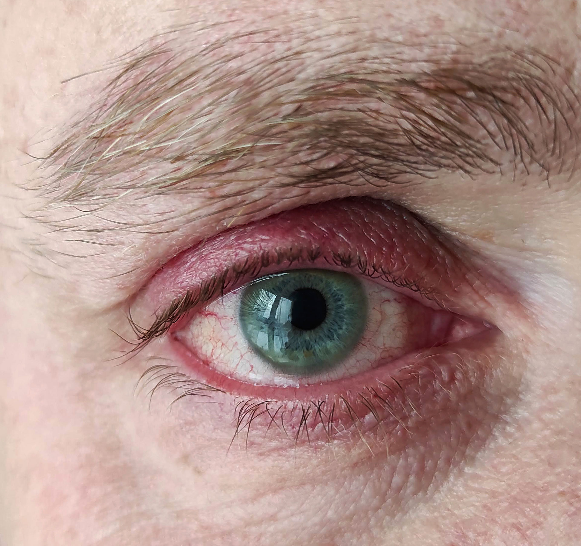Blepharitis eye condition