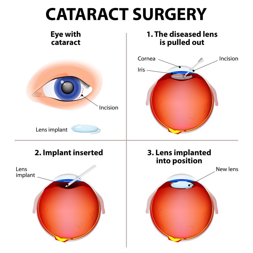 Cataract surgery diagram